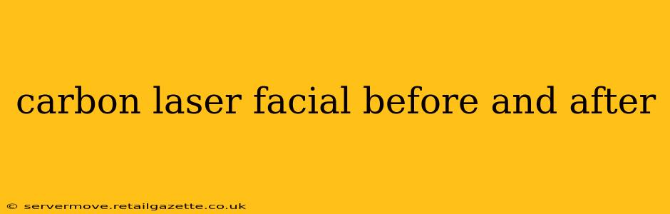 carbon laser facial before and after