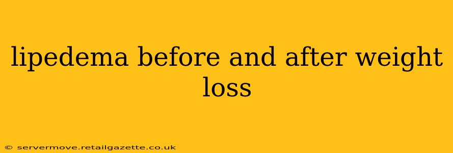 lipedema before and after weight loss