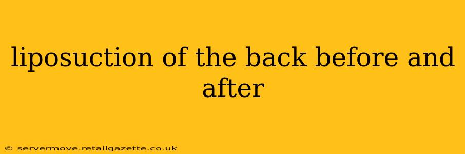 liposuction of the back before and after