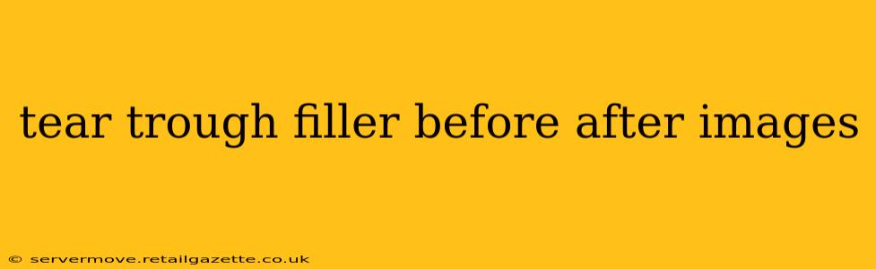 tear trough filler before after images