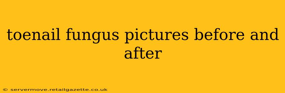 toenail fungus pictures before and after